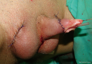 Metaidoioplastik Grundlegendes zu