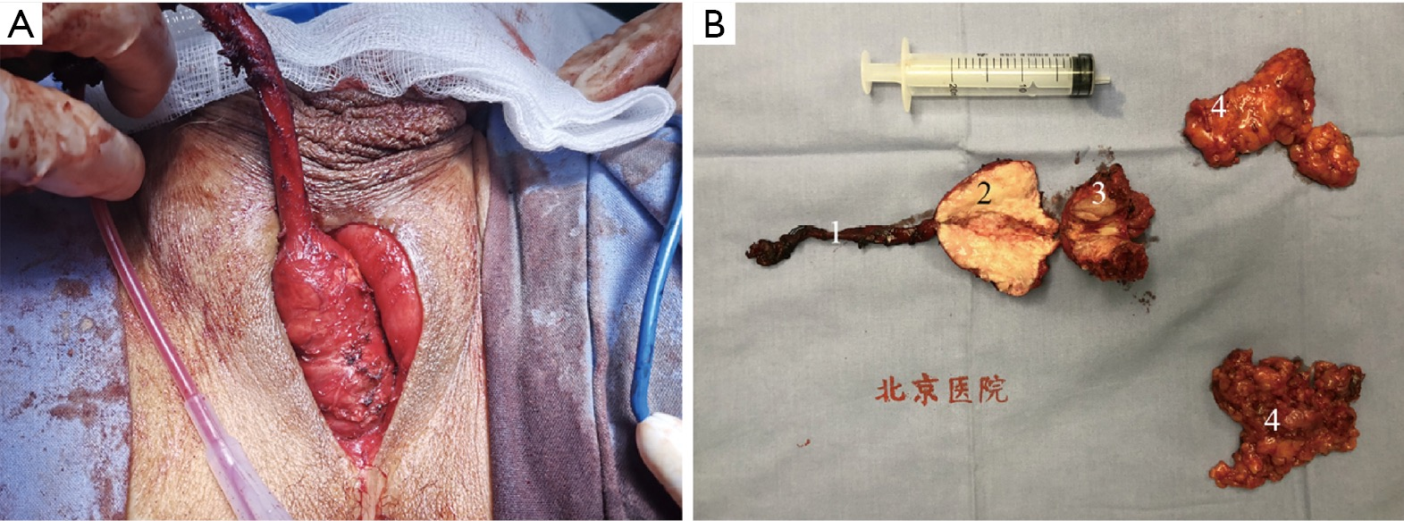 Transperineal-incision urethrectomy combined with laparoscopic