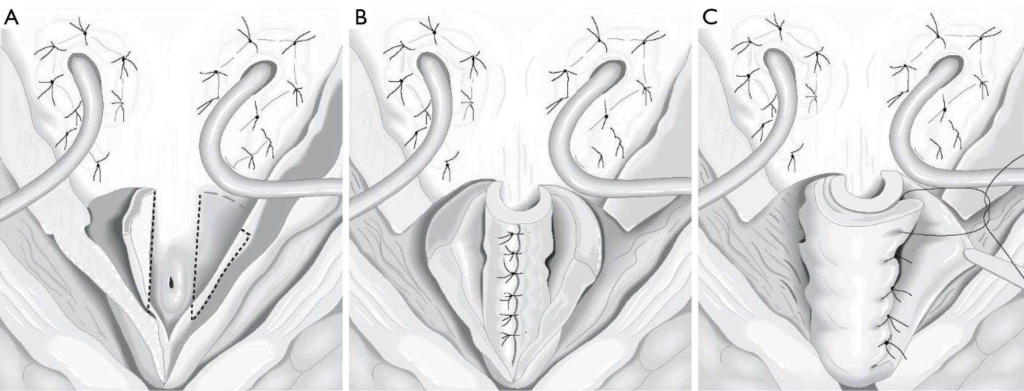 Management Options For Sphincteric Deficiency In Adults With Neurogenic Bladder Myers Translational Andrology And Urology