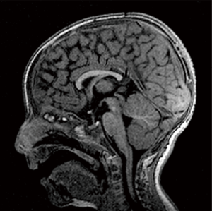 Rubinstein-Taybi syndrome 2 with cerebellar abnormality and neural