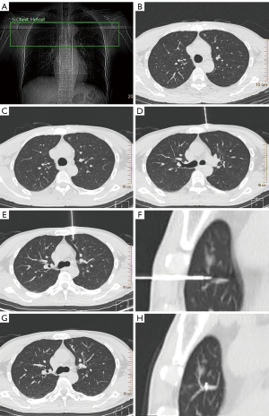 Preoperative CT-guided localization of pulmonary nodules