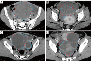 CT-based deep learning segmentation of ovarian cancer and
