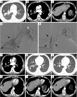 Drug-eluting beads bronchial arterial chemoembolization