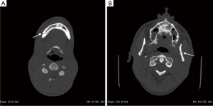 Imaging in traumatic mandibular fractures Naeem Quantitative