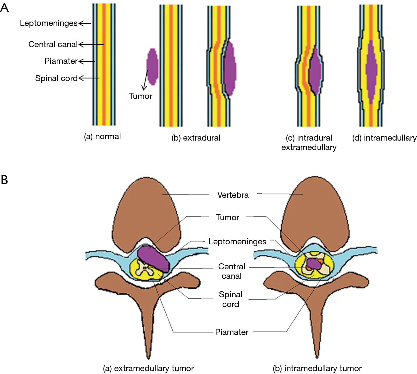 Intramedullary Spinal Cord Metastases And Whole Body 18 F Fdg Pet Ct Case Report Bhatt Quantitative Imaging In Medicine And Surgery