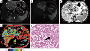 Amide proton transfer-weighted MRI for predicting histological 