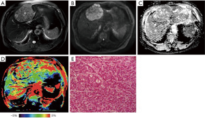 Amide proton transfer-weighted MRI for predicting