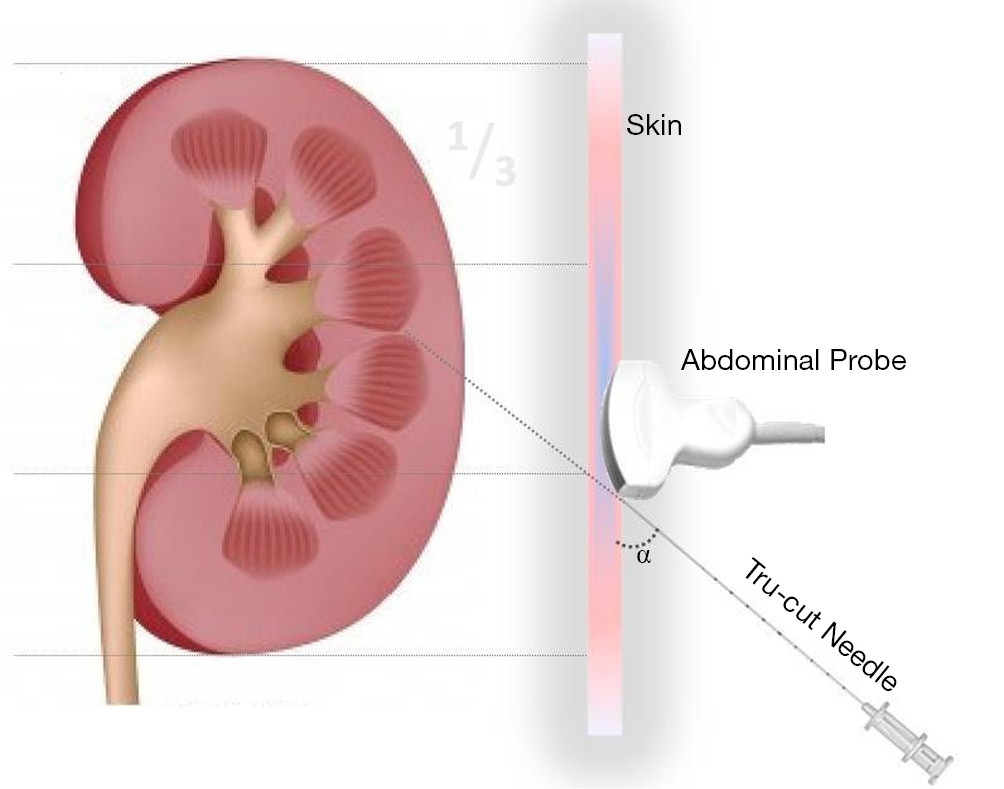 A modified technique for real time ultrasound guided pediatric