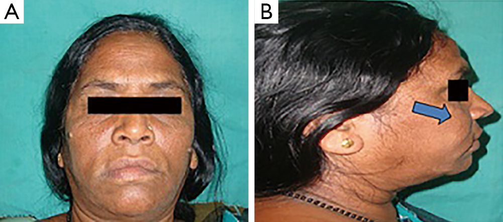 A rare case report of myxoid fibroma of maxilla - Khan - Quantitative ...