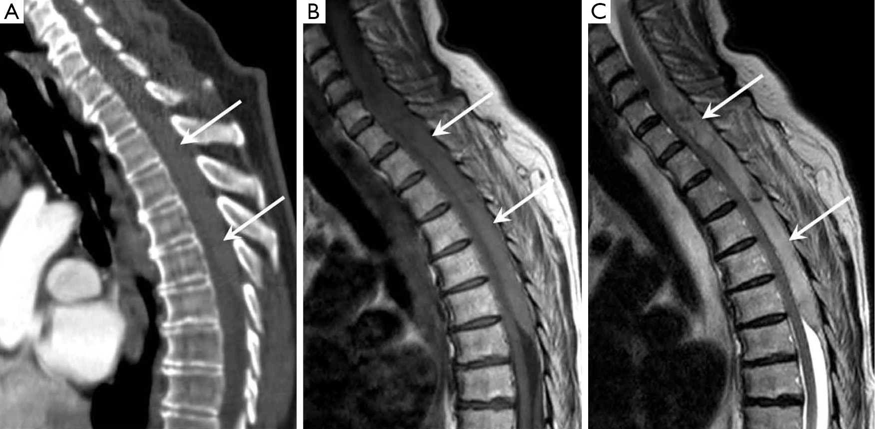Epidural Hematoma MRI