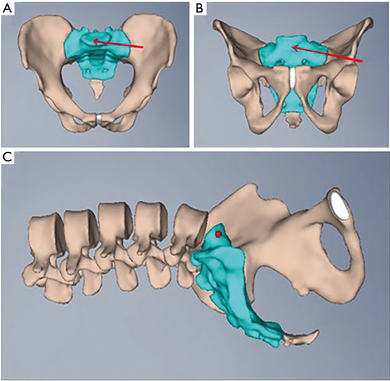 percutaneous sacroiliac screw fixation