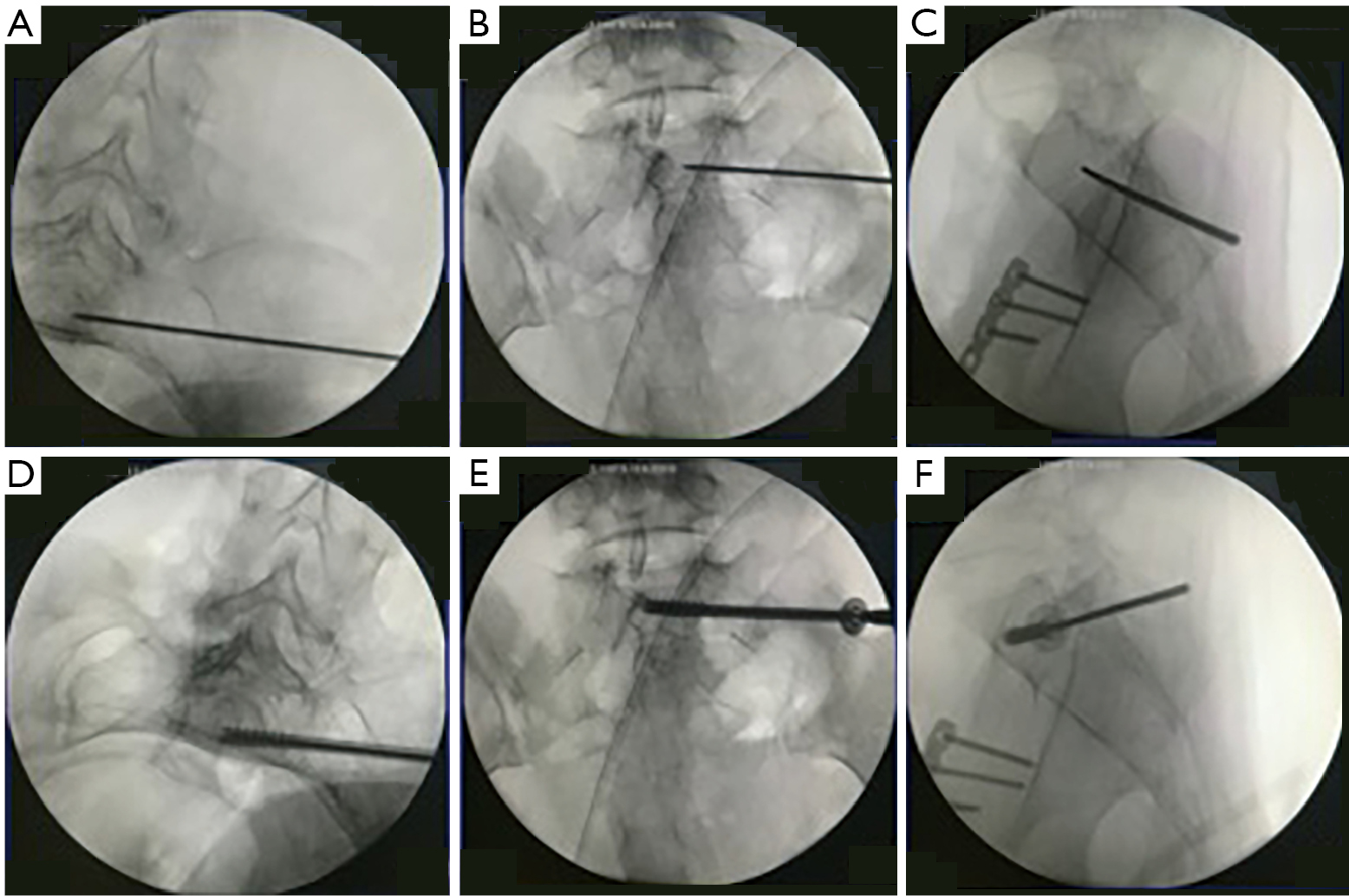 percutaneous sacroiliac screw fixation