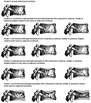 Identifying osteoporotic vertebral fracture - Griffith