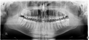 Traumatic genial tubercle fracture: a case description with 9-month  radiographic follow-up and a literature analysis - Albassal - Quantitative  Imaging in Medicine and Surgery