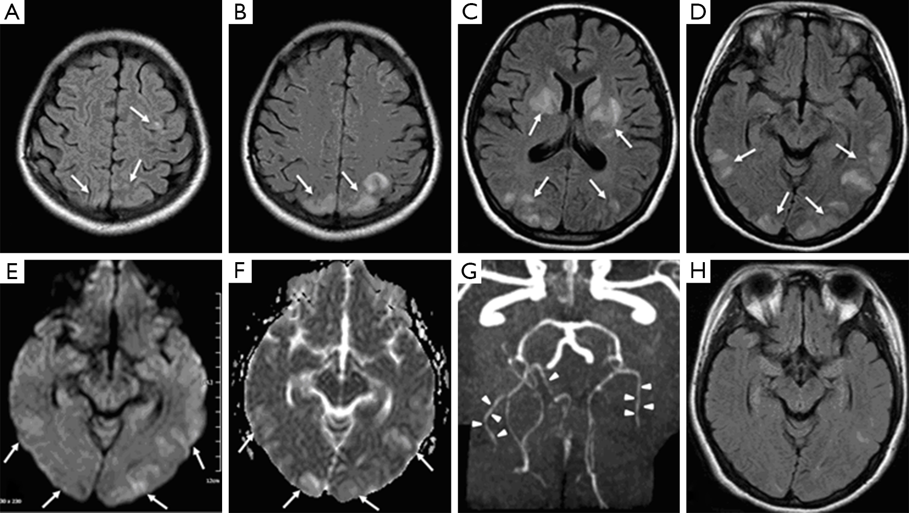 Late postpartum eclampsia complicated with posterior reversible