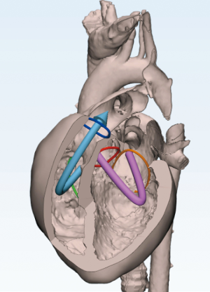 Narrative review of assessing the surgical options for double outlet right  ventricle - Corno - Translational Pediatrics
