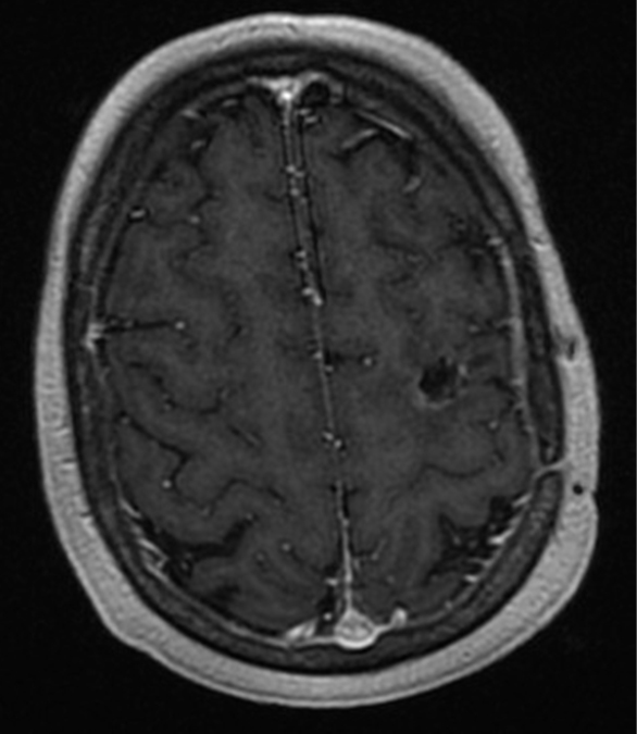 Solitary Brain Metastasis From Prostate Cancer A Case Report Barakat Annals Of Palliative Medicine