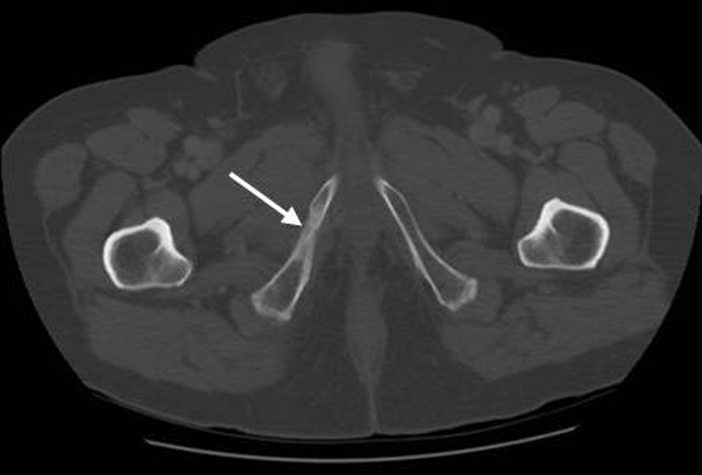 Radiological Changes On Ct After Stereotactic Body Radiation Therapy To Non Spine Bone Metastases A Descriptive Series Chiu Annals Of Palliative Medicine