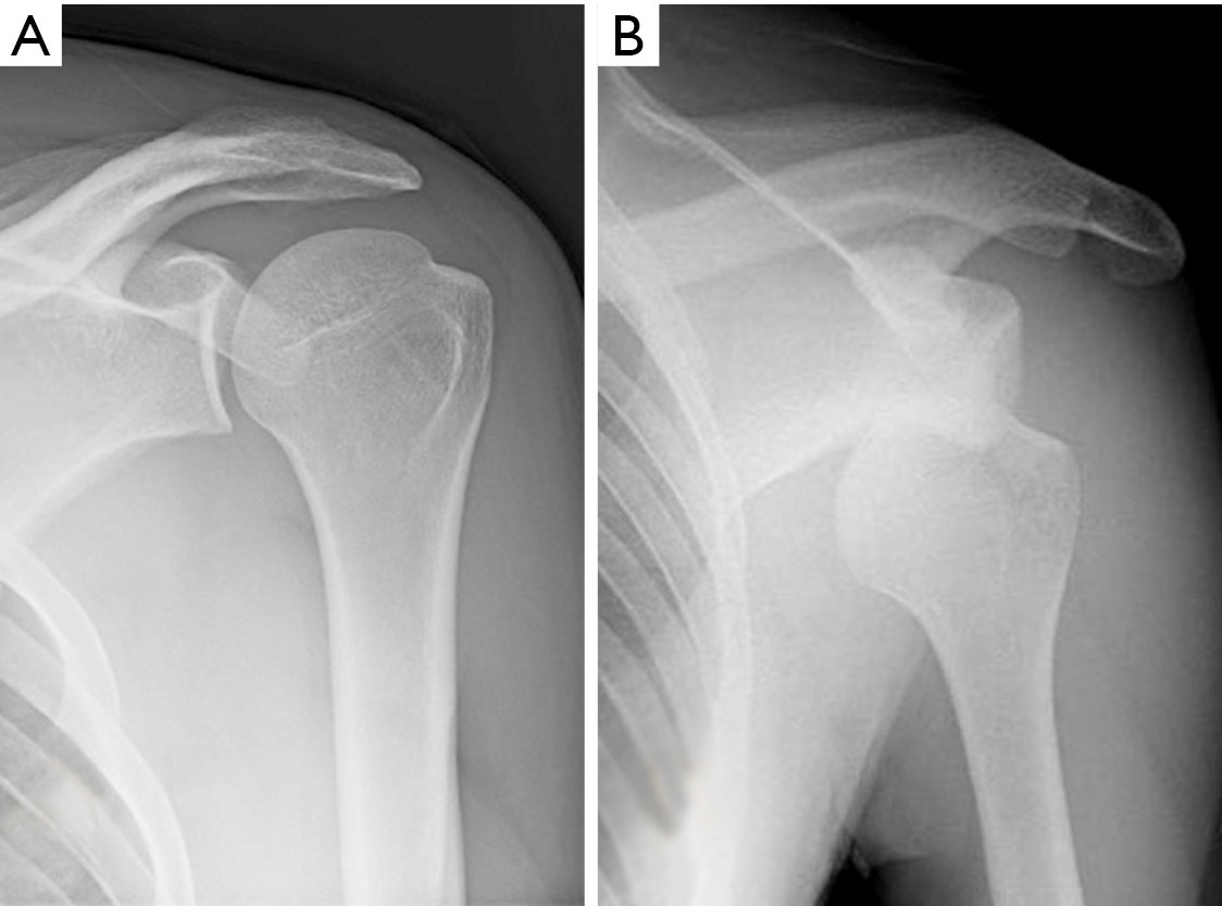 Clinical Anatomy And Stabilizers Of The Glenohumeral Joint Gasbarro Annals Of Joint
