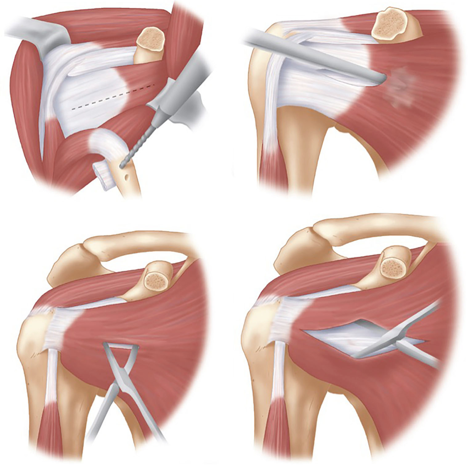 Open Latarjet Tried Tested And True Mattern Annals Of Joint
