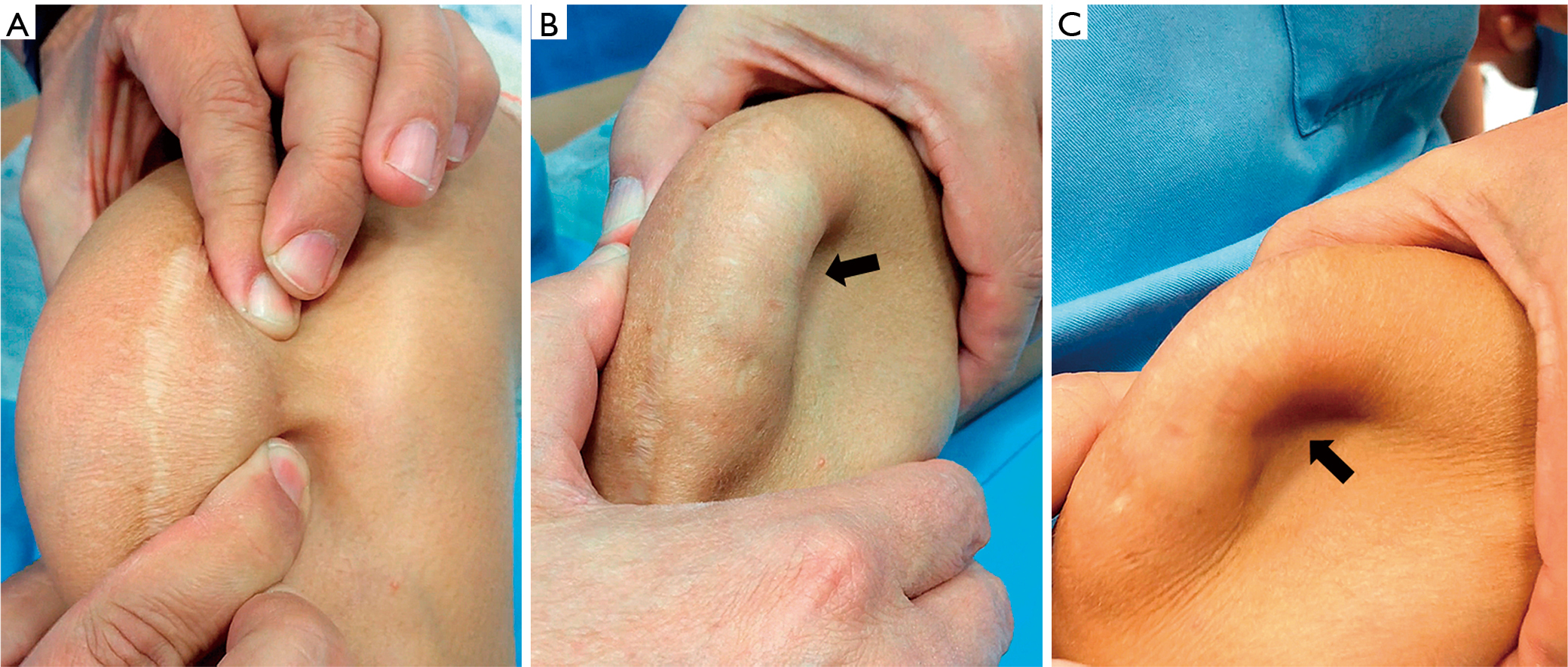 Treating Complications Of Operative Management For Patellofemoral Pain Sanchis Alfonso Annals Of Joint