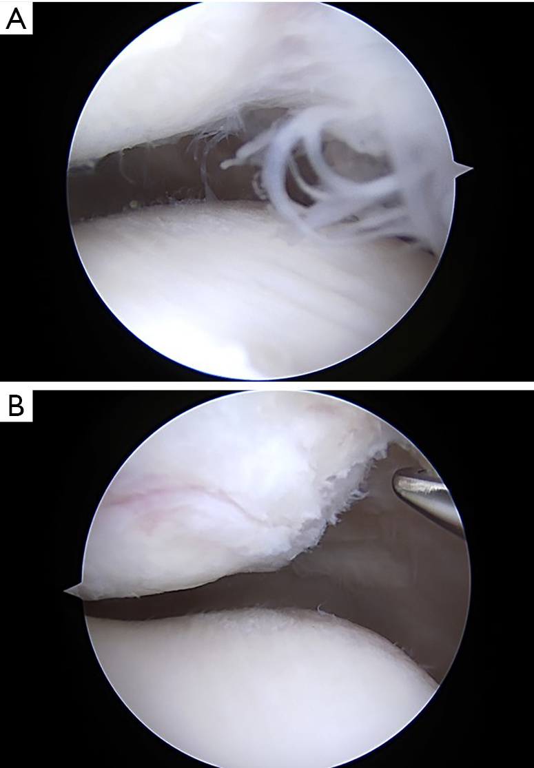 Conservative Surgical Treatment For Anterior Knee Pain Post Annals Of Joint