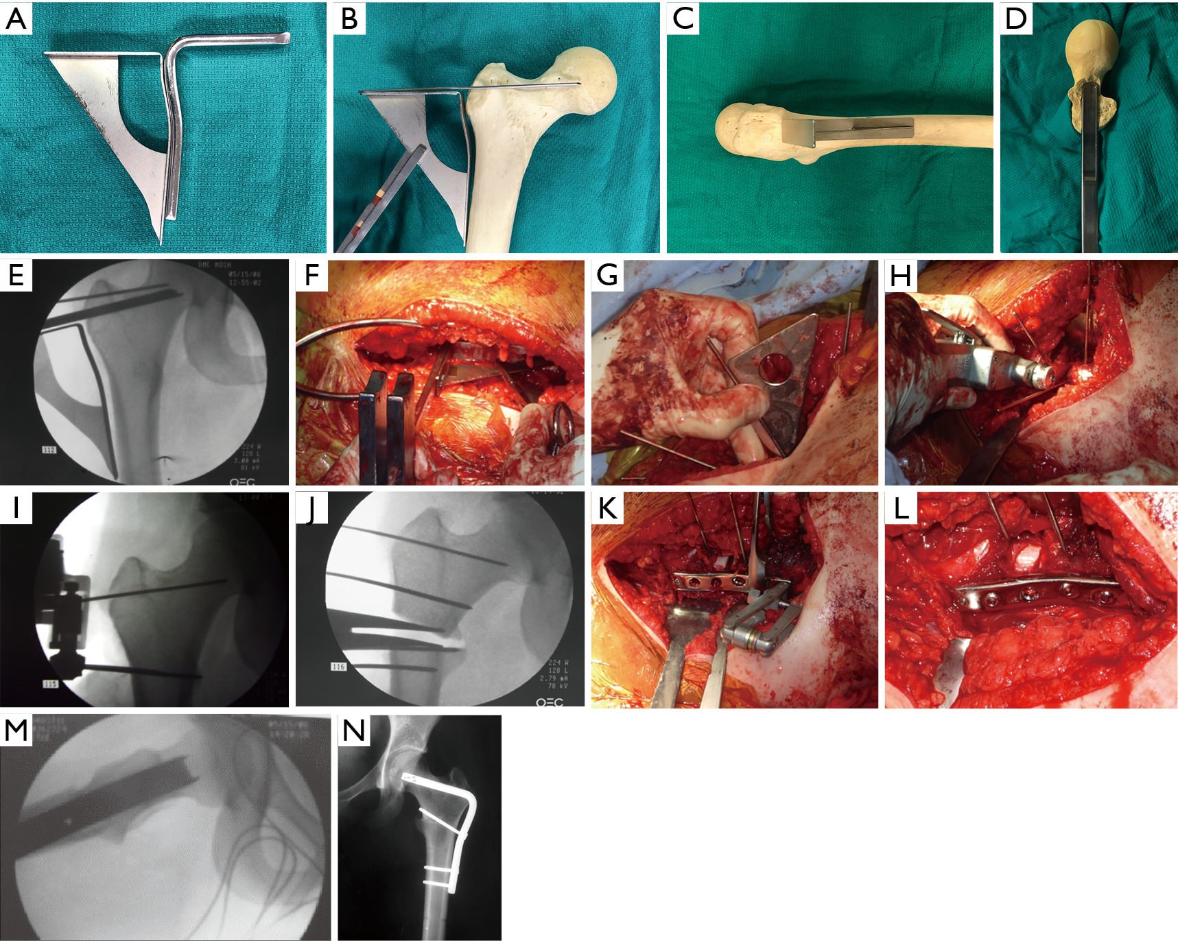 The Power Of Transverse Plane Limb Mal Alignment In The Genesis Of Anterior Knee Pain Clinical Relevance Teitge Annals Of Joint