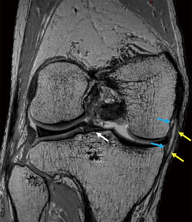 Imaging Evaluation Of The Multiligament Injured Knee Helito Annals Of Joint Anatomy of the knee can be complicated and hard to understand. multiligament injured knee