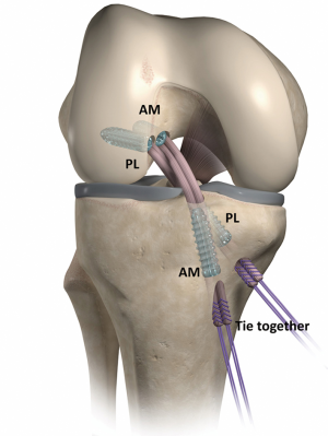 Anatomic Double Bundle Anterior Cruciate Ligament Reconstruction Using Soft Tissue Interference Screw Fixation Jarvela Annals Of Joint