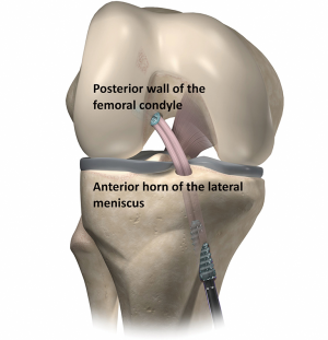 Anatomic Double Bundle Anterior Cruciate Ligament Reconstruction Using Soft Tissue Interference Screw Fixation Jarvela Annals Of Joint
