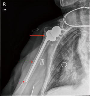 Reverse Shoulder Arthroplasty: Diagnostic And Treatment Options For The  Infected Reverse - Stone - Annals Of Joint