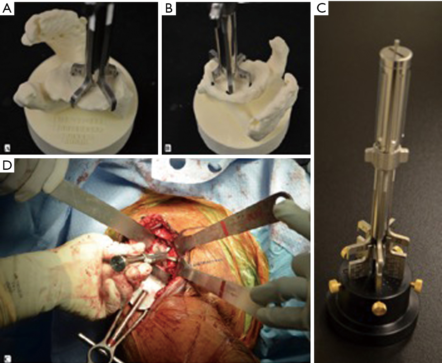 Pre-operative planning for reverse shoulder replacement: the surgical benefits and their clinical translation - Rodríguez - Annals of Joint Pre-operative planning for reverse shoulder replacement: the surgical benefits and their clinical translation - Rodríguez - Annals of Joint