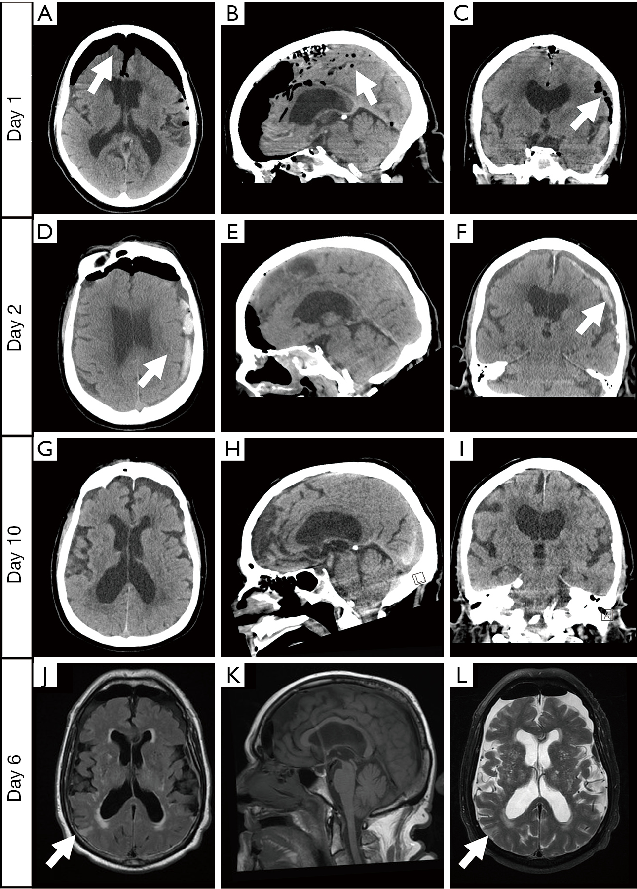 Nothing to sneeze at: tension pneumocephalus causing an acute stroke ...