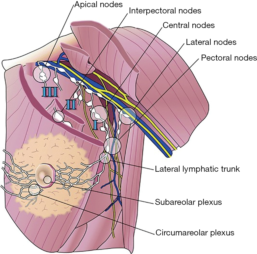 A Case Of Locoregional Recurrence Of Breast Cancer In The Interpectoral