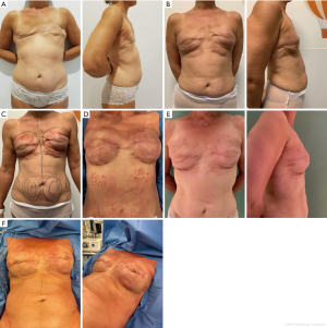 Optimizing aesthetic results in free flap breast reconstruction: fat  grafting and Hamdi's Hammock - Ramaut - Annals of Breast Surgery