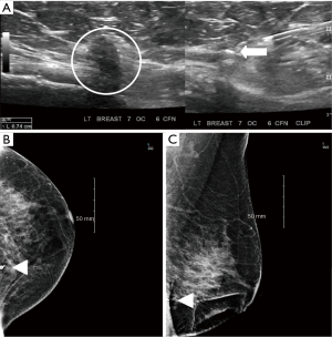 Techniques for overcoming a missing clip during pre-operative needle  localization for lumpectomy: case report - Johnson - Annals of Breast  Surgery
