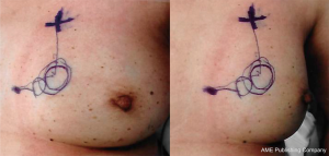 Techniques for overcoming a missing clip during pre-operative needle  localization for lumpectomy: case report - Johnson - Annals of Breast  Surgery