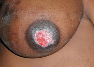 Is it breast cancer? —common dermatologic disorders found on the breast -  Throckmorton - Annals of Breast Surgery
