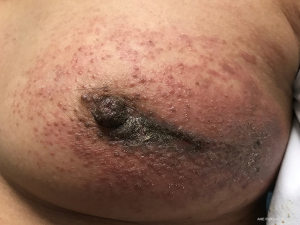 Been getting open sores on my breasts for about a year now. :  r/doihavebreastcancer