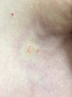 Been getting open sores on my breasts for about a year now. :  r/doihavebreastcancer