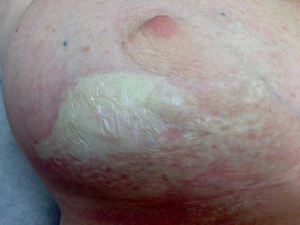 Painful thickened breast lesion