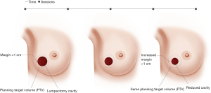 Accelerated partial breast irradiation: current status and future  directions - Refaat - Annals of Breast Surgery