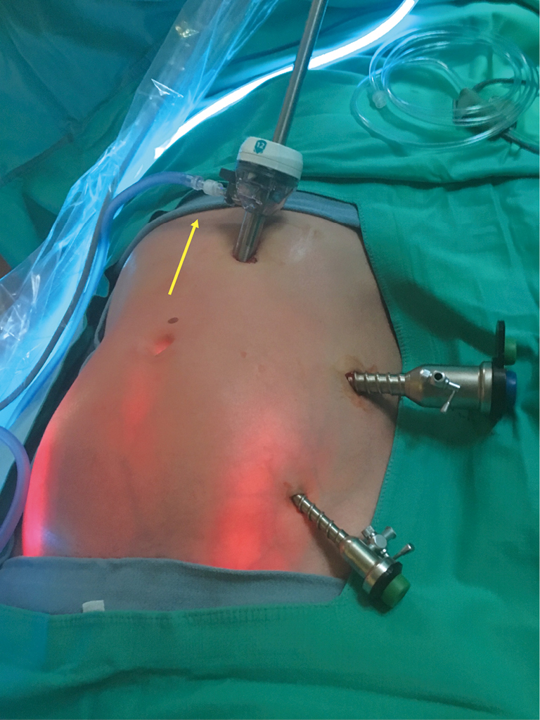 Laparoscopic umbilical herniorrhaphy: a novel technique of hernia neck closure and outcomes in the first 19 cases - Vetter - Laparoscopic Surgery Laparoscopic umbilical herniorrhaphy: a novel technique of hernia neck closure and outcomes in the first 19 cases - Vetter - Laparoscopic Surgery
