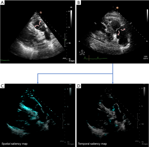 Selected video frame from a 2D echocardiogram in a parasternal