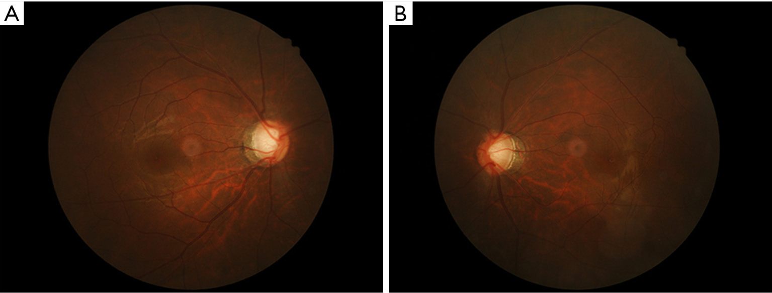 Posner Schlossman Syndrome A 10 Year Review Of Clinical Experience Wang Annals Of Eye Science