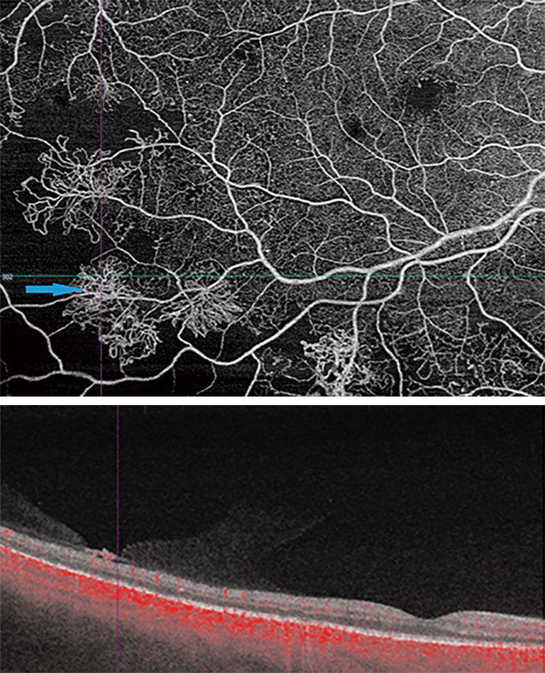 New Findings And Challenges In Oct Angiography For Diabetic Retinopathy Sorour Annals Of Eye Science