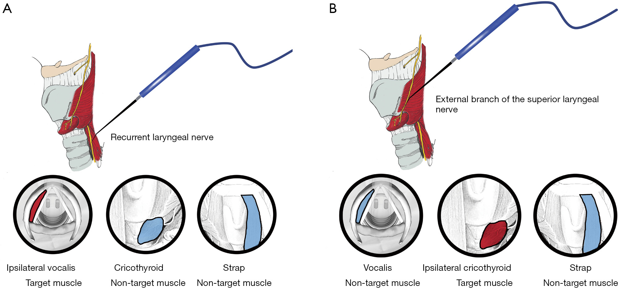 The Evolution And Progress Of Standard Procedures For Intraoperative Nerve Monitoring Sinclair Annals Of Thyroid