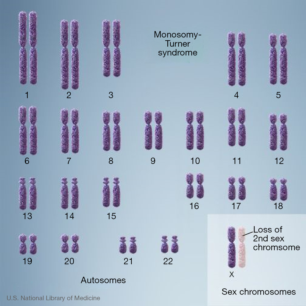 Gonadal Dysgenesis A Clinical Overview Of Turner Syndrome Clemente Pediatric Medicine