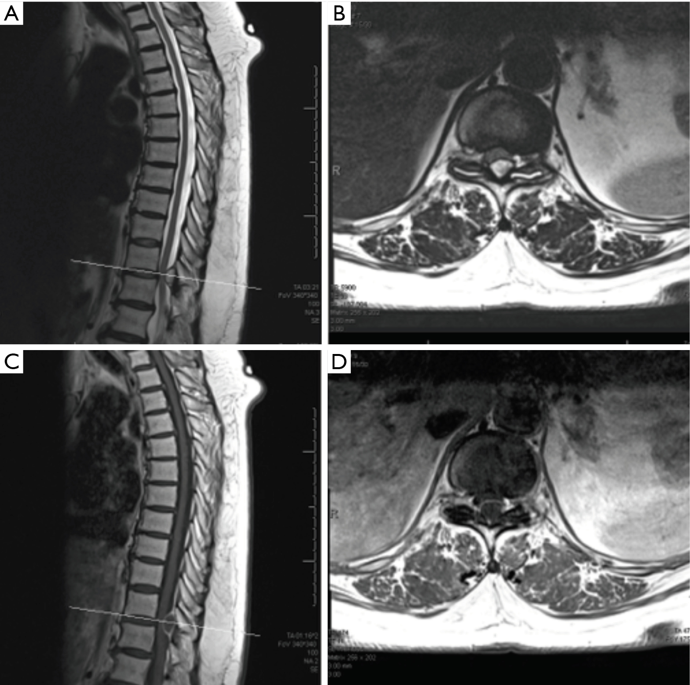 Thoracic Juxtafacet Cyst Jfc A Cause Of Spinal Myelopathy Janjua Journal Of Spine Surgery