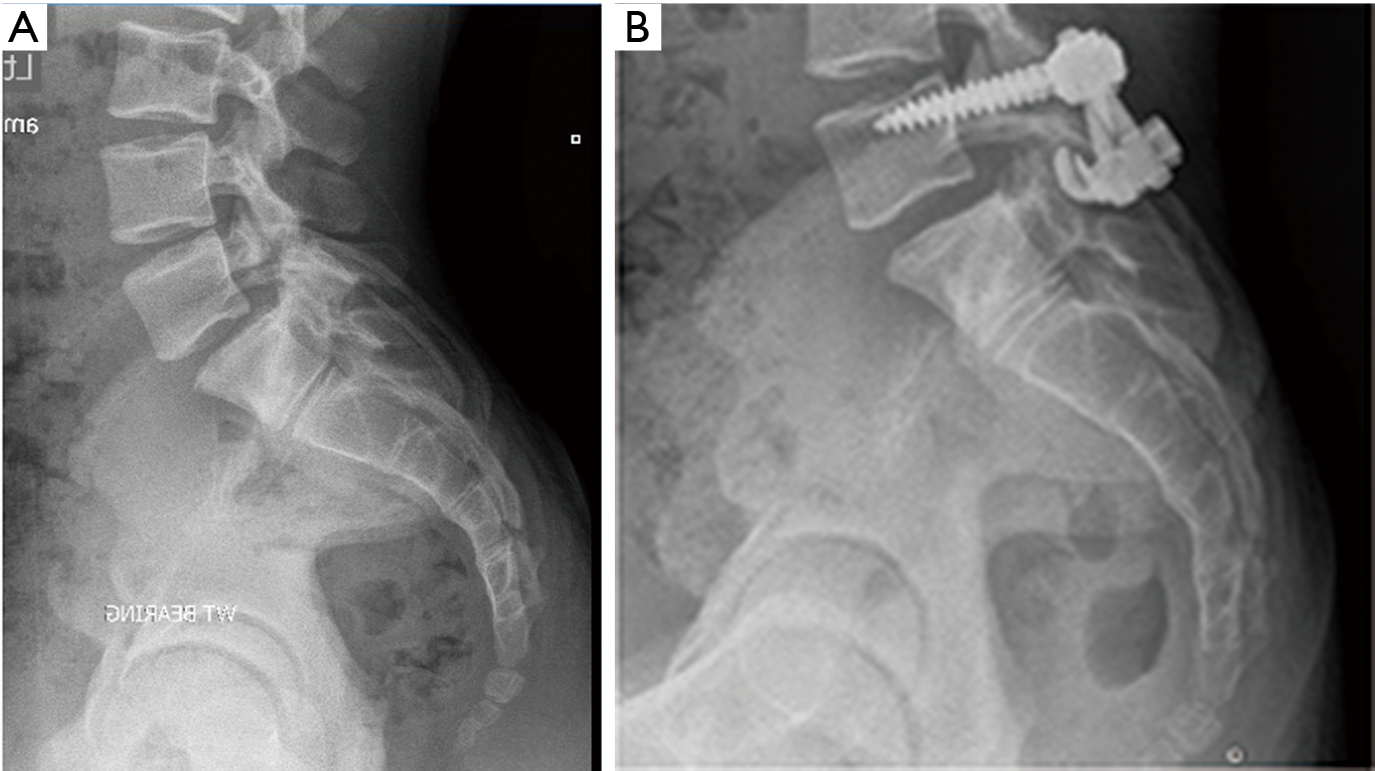 Spondylolisthesis exercises image